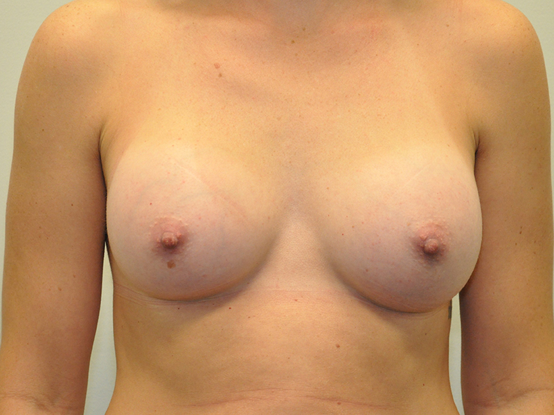 Grand Rapids Breast Augmentation before 1