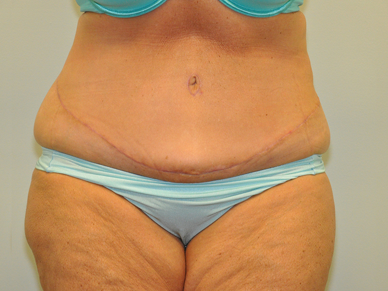 Body Lift Before and After | Steven Ringler MD - Center for Aesthetics And Plastic Surgery
