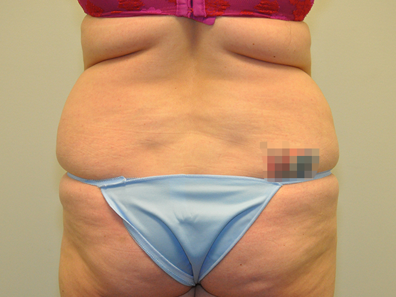 Michigan liposuction before 1
