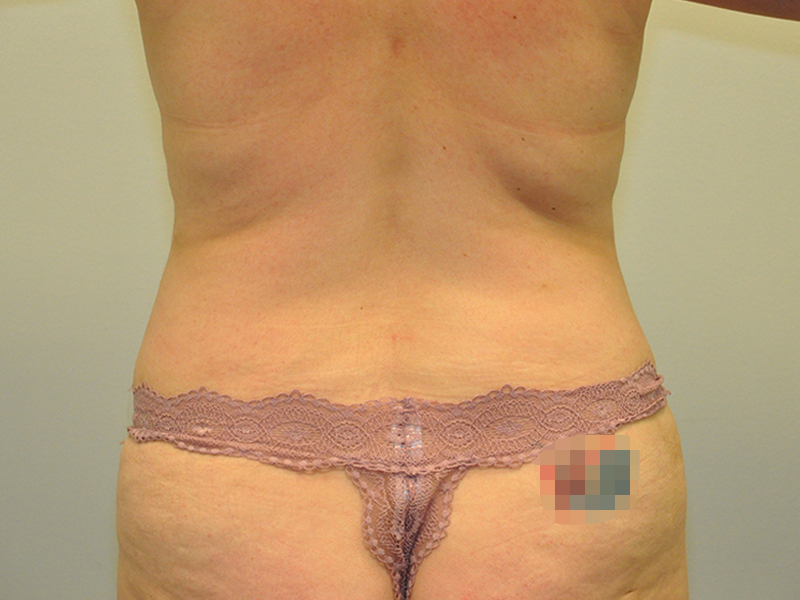 Liposuction Before and After | Steven Ringler MD - Center for Aesthetics And Plastic Surgery