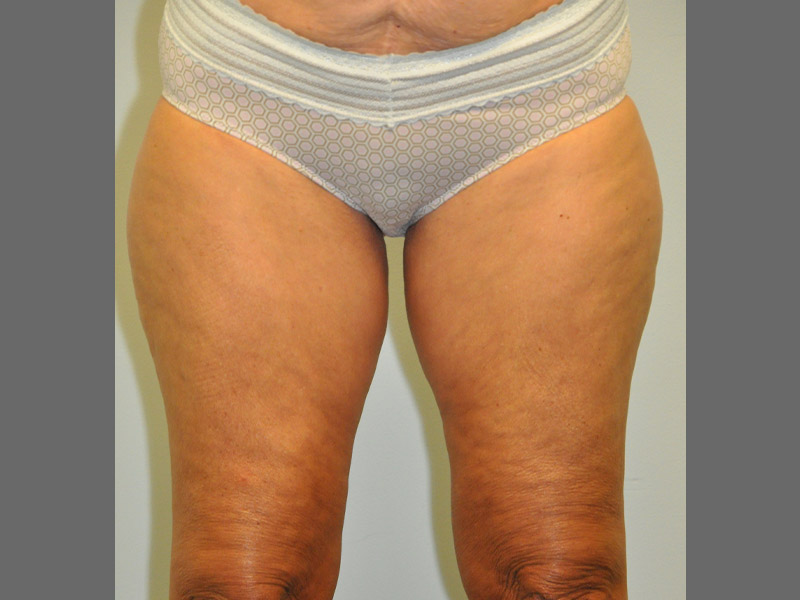 Liposuction Before and After | Steven Ringler MD - Center for Aesthetics And Plastic Surgery