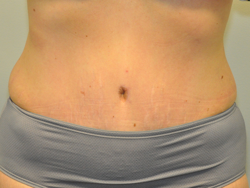 Tummy Tuck Before and After | Steven Ringler MD - Center for Aesthetics And Plastic Surgery