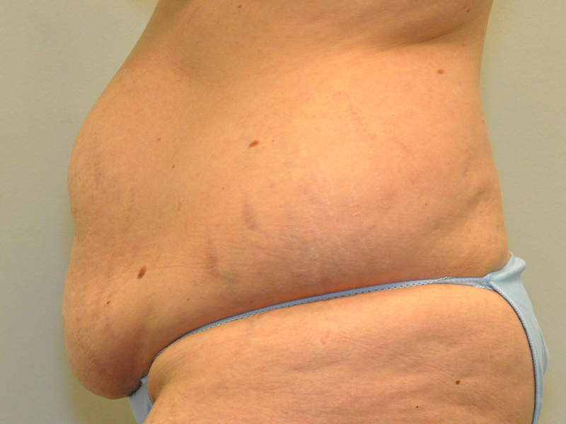 Tummy Tuck Before and After | Steven Ringler MD - Center for Aesthetics And Plastic Surgery