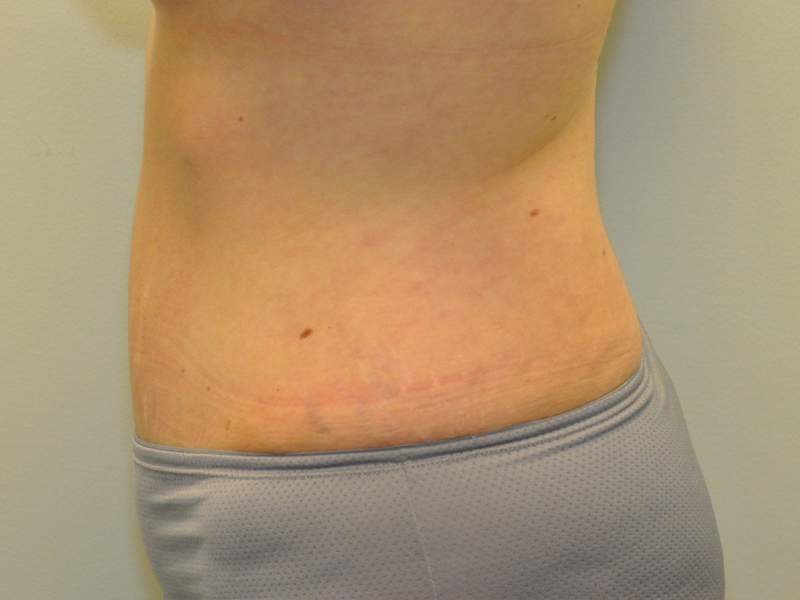 Tummy Tuck Before and After | Steven Ringler MD - Center for Aesthetics And Plastic Surgery