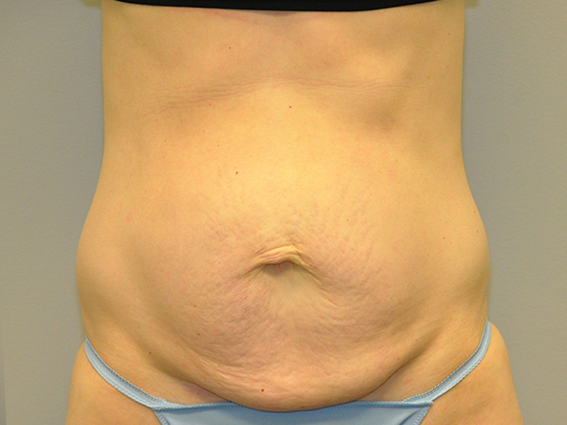 Tummy Tuck Before and After | Steven Ringler MD - Center for Aesthetics And Plastic Surgery