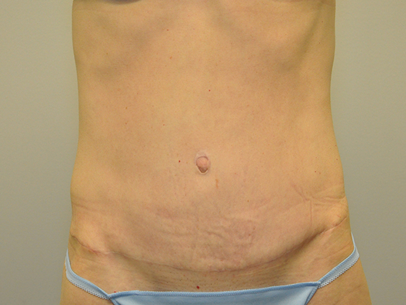 Tummy Tuck Before and After | Steven Ringler MD - Center for Aesthetics And Plastic Surgery