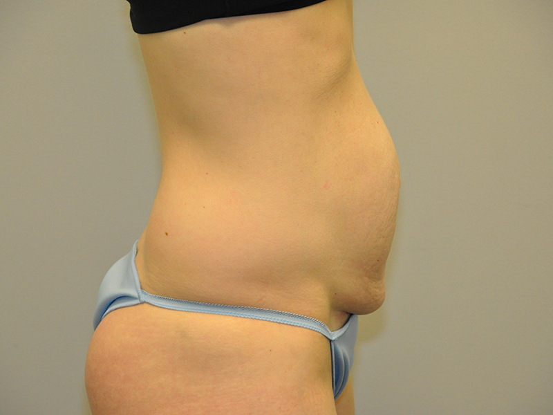 Tummy Tuck Before and After | Steven Ringler MD - Center for Aesthetics And Plastic Surgery