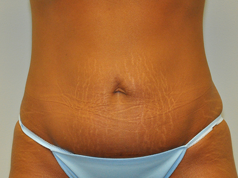 Grand Rapids Tummy Tuck