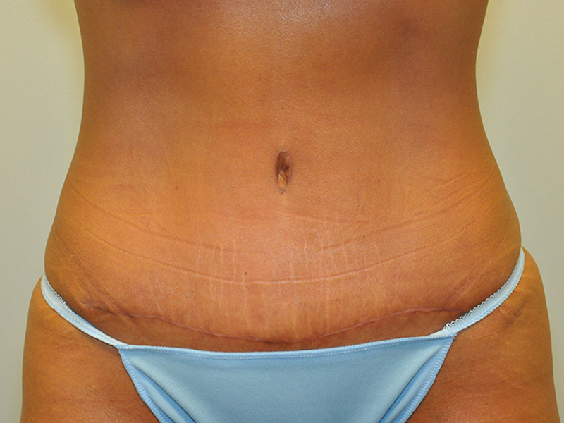 Tummy Tuck Michigan