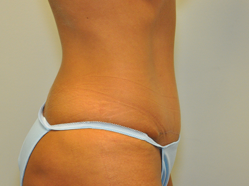 Tummy Tuck Before and After | Steven Ringler MD - Center for Aesthetics And Plastic Surgery