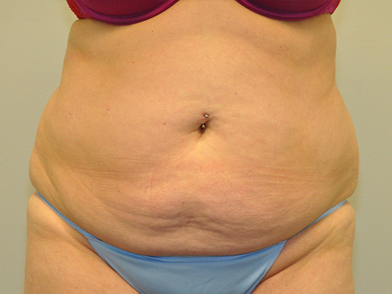 Tummy Tuck Before and After | Steven Ringler MD - Center for Aesthetics And Plastic Surgery