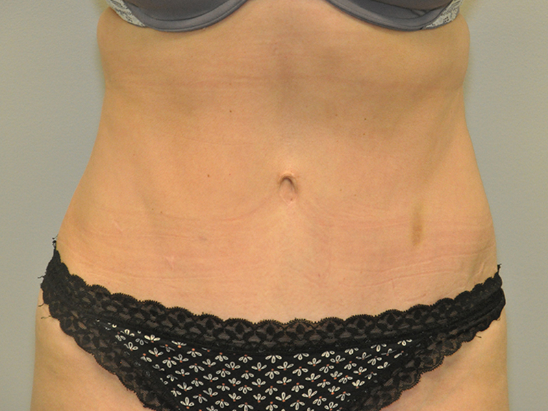 Tummy Tuck Before and After | Steven Ringler MD - Center for Aesthetics And Plastic Surgery