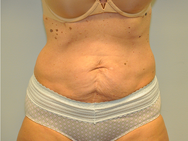 Tummy Tuck Before and After | Steven Ringler MD - Center for Aesthetics And Plastic Surgery