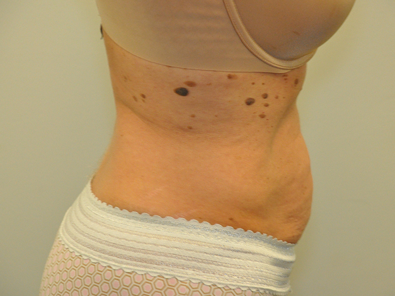 Tummy Tuck Before and After | Steven Ringler MD - Center for Aesthetics And Plastic Surgery