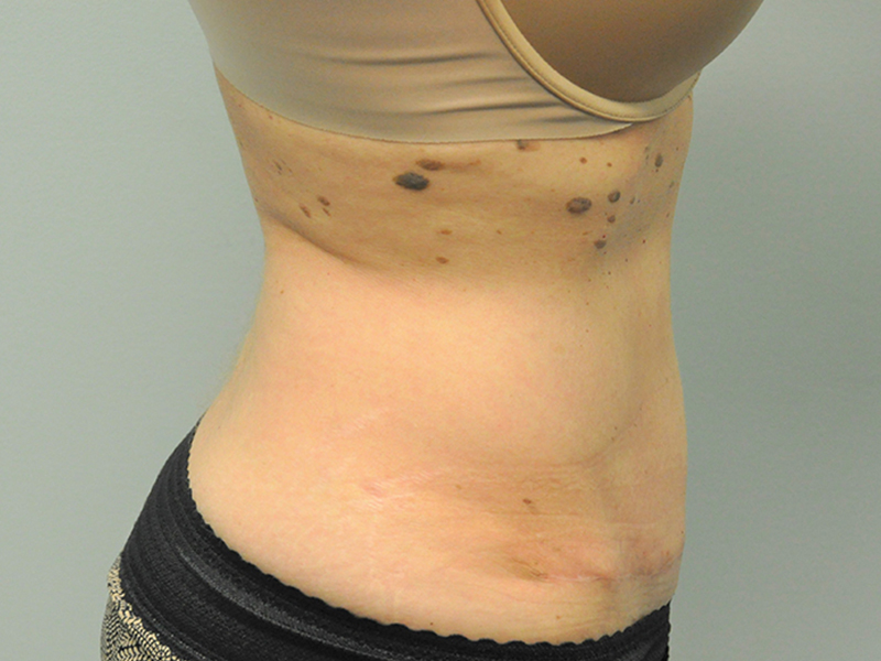 Tummy Tuck Before and After | Steven Ringler MD - Center for Aesthetics And Plastic Surgery