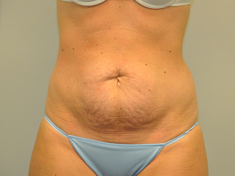 Tummy Tuck Before and After | Steven Ringler MD - Center for Aesthetics And Plastic Surgery