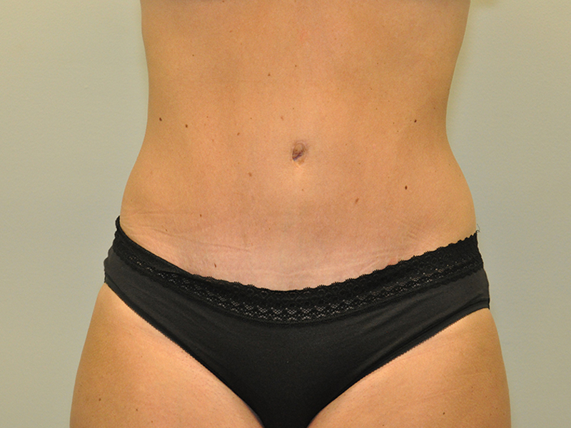 Tummy Tuck Before and After | Steven Ringler MD - Center for Aesthetics And Plastic Surgery