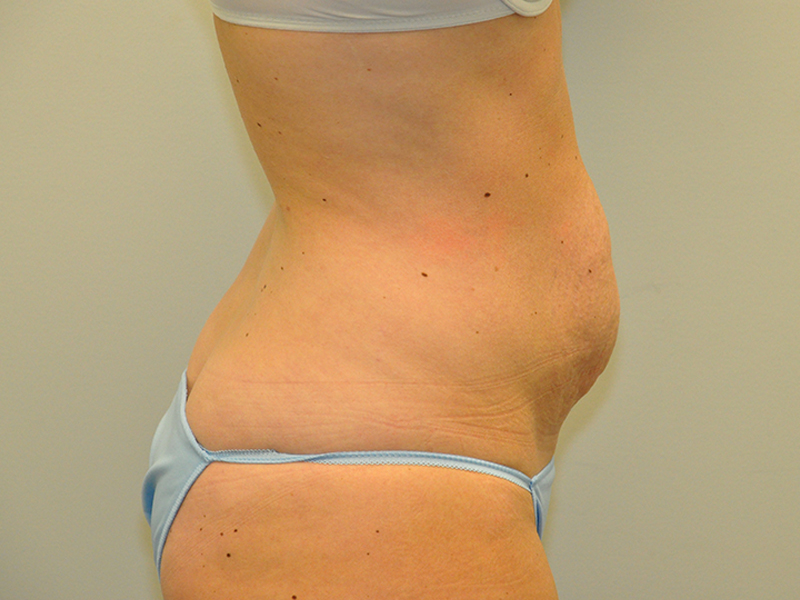 Tummy Tuck Before and After | Steven Ringler MD - Center for Aesthetics And Plastic Surgery