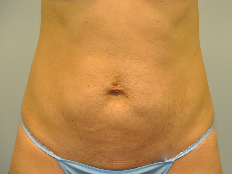 Tummy Tuck Before and After | Steven Ringler MD - Center for Aesthetics And Plastic Surgery