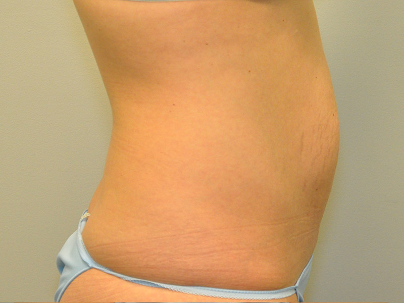 Tummy Tuck Before and After | Steven Ringler MD - Center for Aesthetics And Plastic Surgery