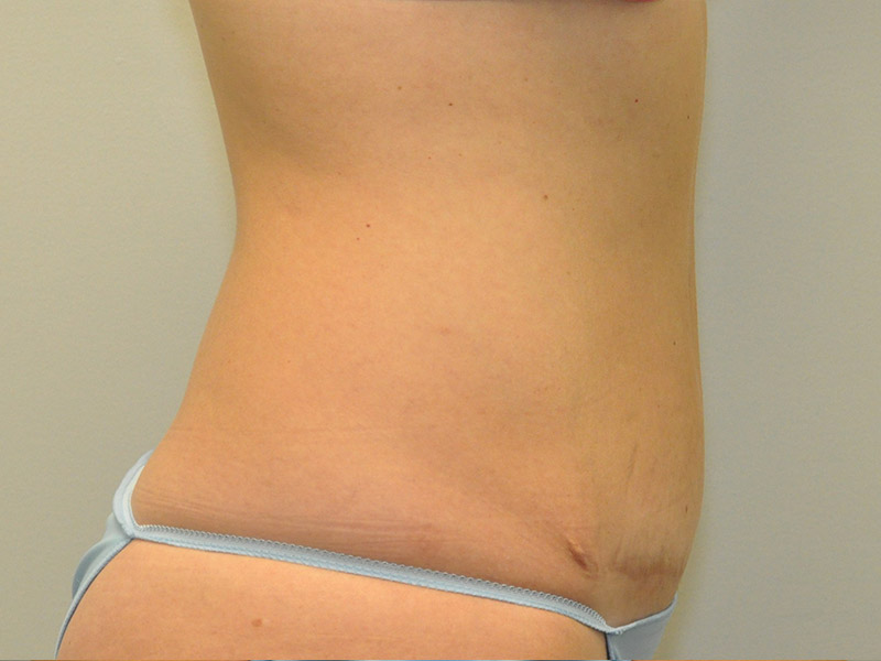 Tummy Tuck Before and After | Steven Ringler MD - Center for Aesthetics And Plastic Surgery