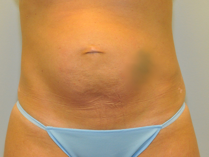 Tummy Tuck Before and After | Steven Ringler MD - Center for Aesthetics And Plastic Surgery