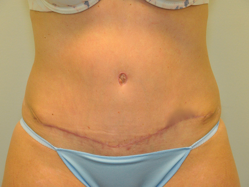 Tummy Tuck Before and After | Steven Ringler MD - Center for Aesthetics And Plastic Surgery