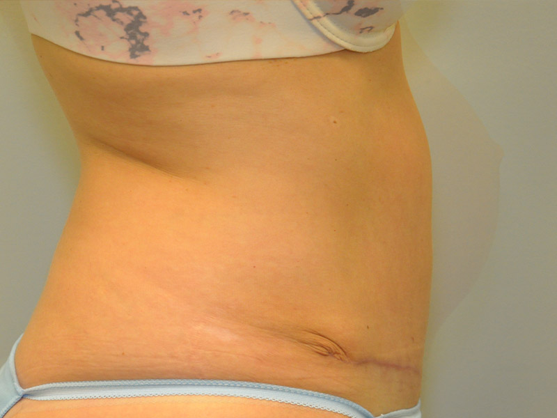 Tummy Tuck Before and After | Steven Ringler MD - Center for Aesthetics And Plastic Surgery