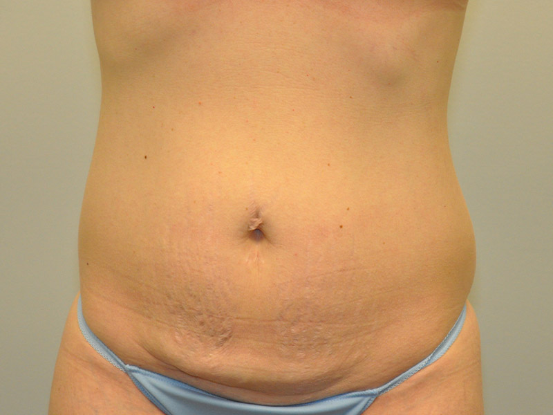 Grand Rapids Tummy Tuck