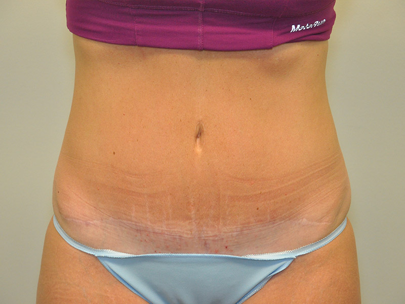 Tummy Tuck Before and After | Steven Ringler MD - Center for Aesthetics And Plastic Surgery