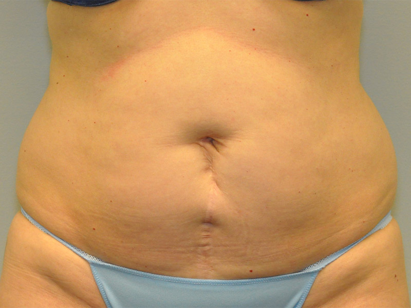 Tummy Tuck Before and After | Steven Ringler MD - Center for Aesthetics And Plastic Surgery