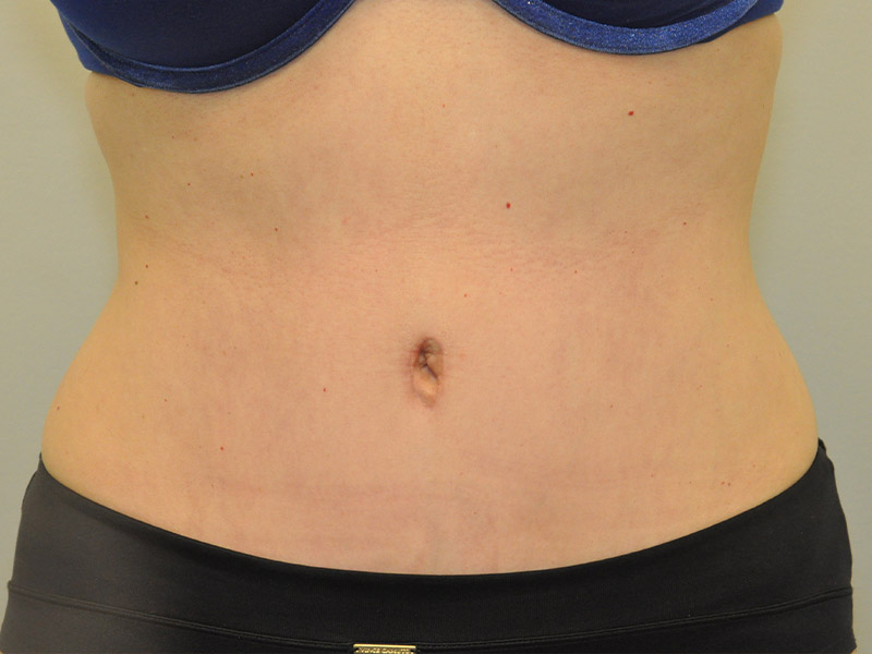 Tummy Tuck Before and After | Steven Ringler MD - Center for Aesthetics And Plastic Surgery