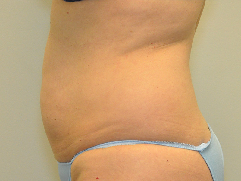 Tummy Tuck Before and After | Steven Ringler MD - Center for Aesthetics And Plastic Surgery