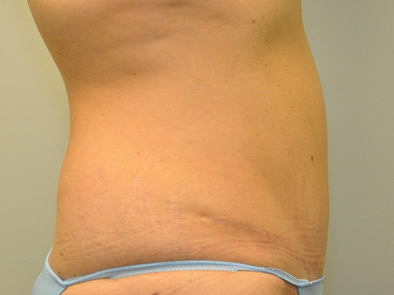 Tummy Tuck Before and After | Steven Ringler MD - Center for Aesthetics And Plastic Surgery