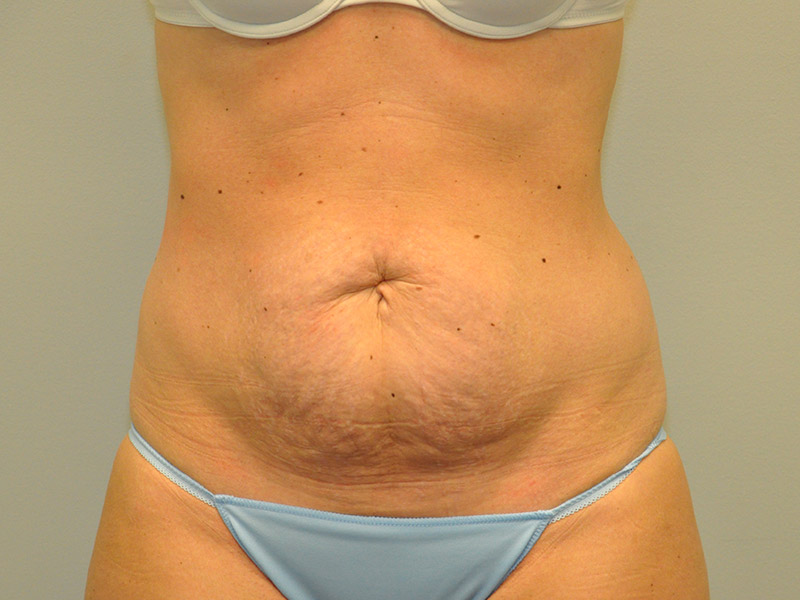 Tummy Tuck Before and After | Steven Ringler MD - Center for Aesthetics And Plastic Surgery