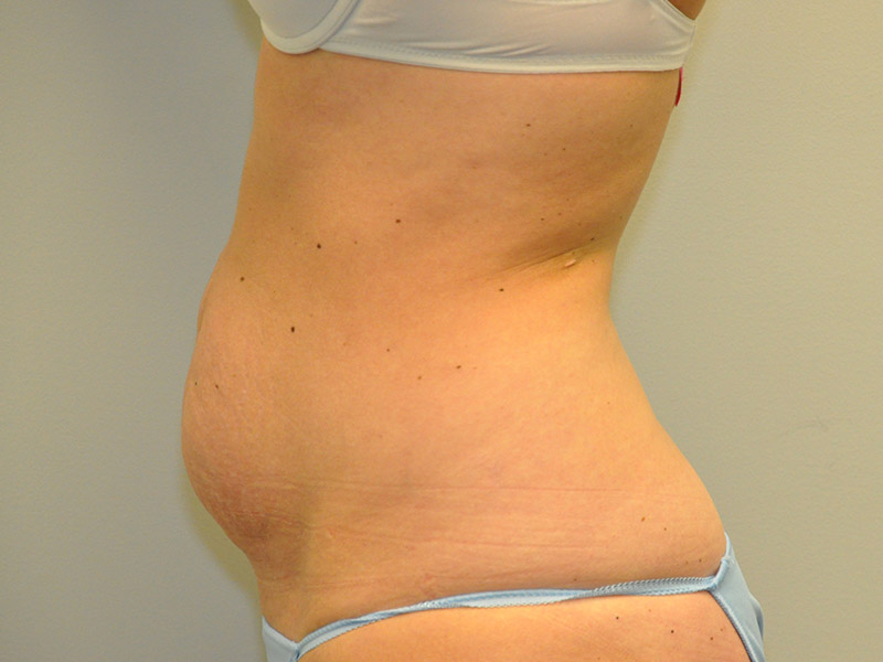 Tummy Tuck Before and After | Steven Ringler MD - Center for Aesthetics And Plastic Surgery