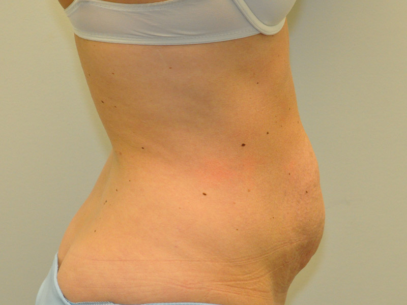 Tummy Tuck Before and After | Steven Ringler MD - Center for Aesthetics And Plastic Surgery