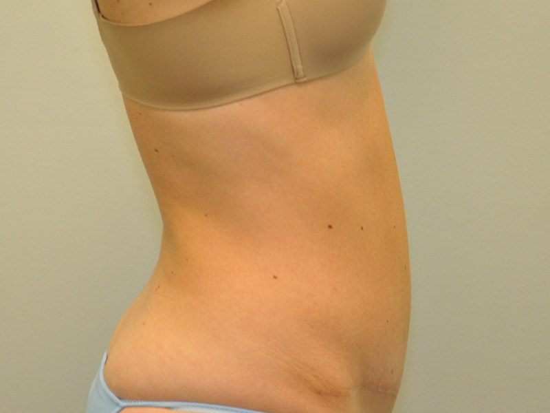 Tummy Tuck Before and After | Steven Ringler MD - Center for Aesthetics And Plastic Surgery