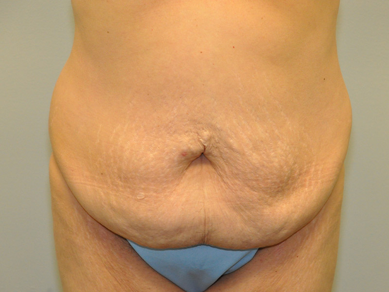 Tummy Tuck Before and After | Steven Ringler MD - Center for Aesthetics And Plastic Surgery