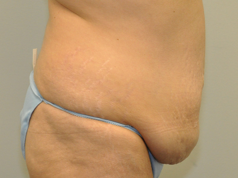 Tummy Tuck Before and After | Steven Ringler MD - Center for Aesthetics And Plastic Surgery