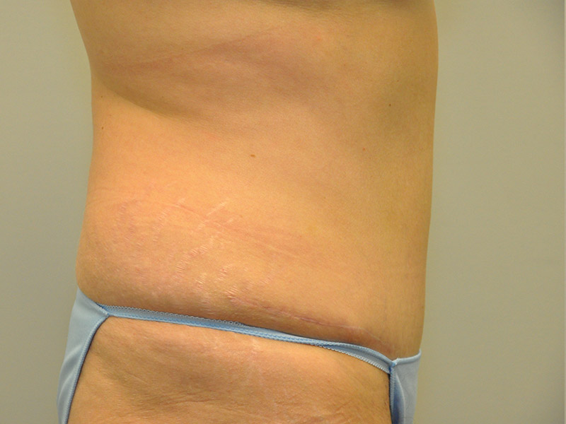 Tummy Tuck Before and After | Steven Ringler MD - Center for Aesthetics And Plastic Surgery