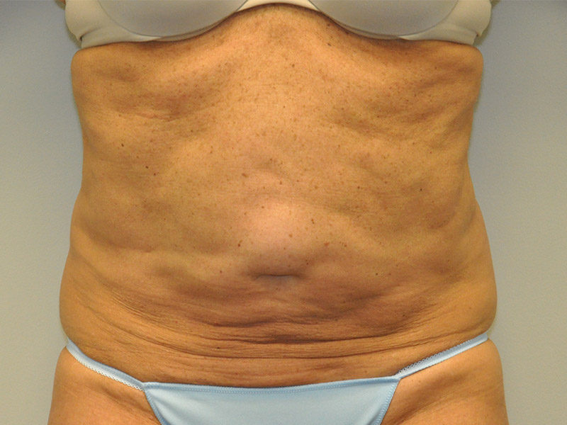 Tummy Tuck Before and After | Steven Ringler MD - Center for Aesthetics And Plastic Surgery