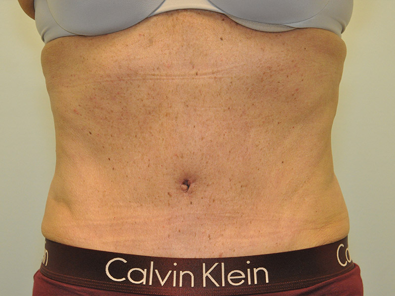 Tummy Tuck Before and After | Steven Ringler MD - Center for Aesthetics And Plastic Surgery