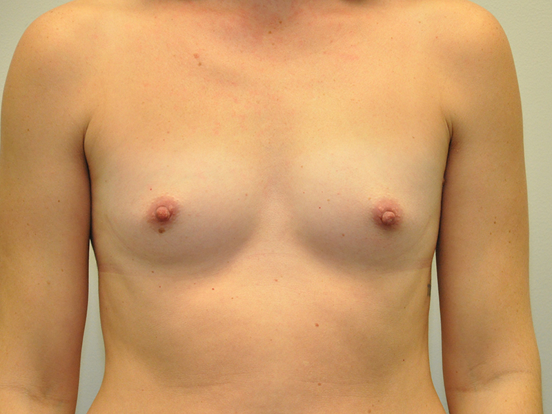 Breast Augmentation Before and After | Steven Ringler MD - Center for Aesthetics And Plastic Surgery