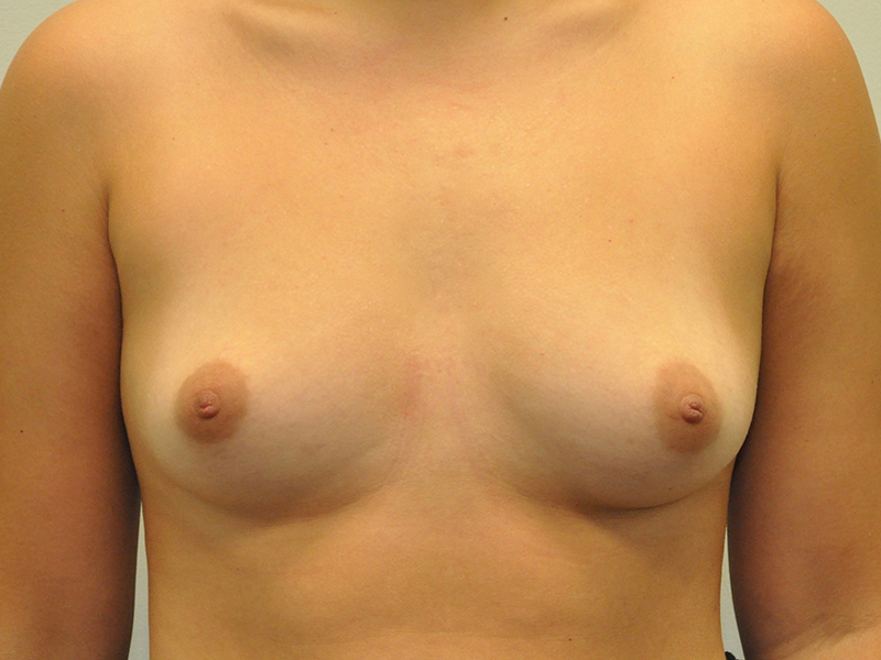 Breast Augmentation Before and After | Steven Ringler MD - Center for Aesthetics And Plastic Surgery