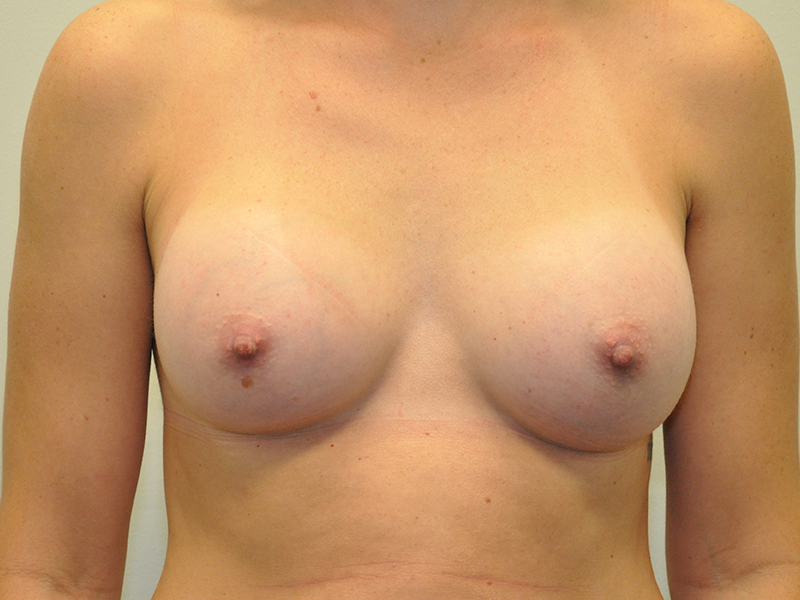 Breast Augmentation Before and After | Steven Ringler MD - Center for Aesthetics And Plastic Surgery