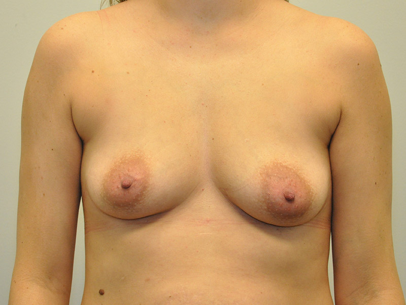 Breast Augmentation Before and After | Steven Ringler MD - Center for Aesthetics And Plastic Surgery