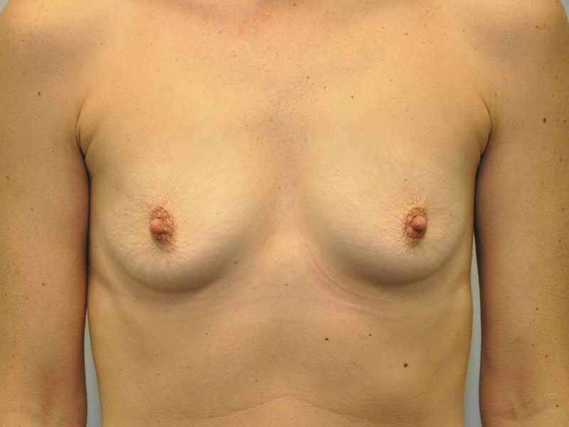 Breast Augmentation Before and After | Steven Ringler MD - Center for Aesthetics And Plastic Surgery