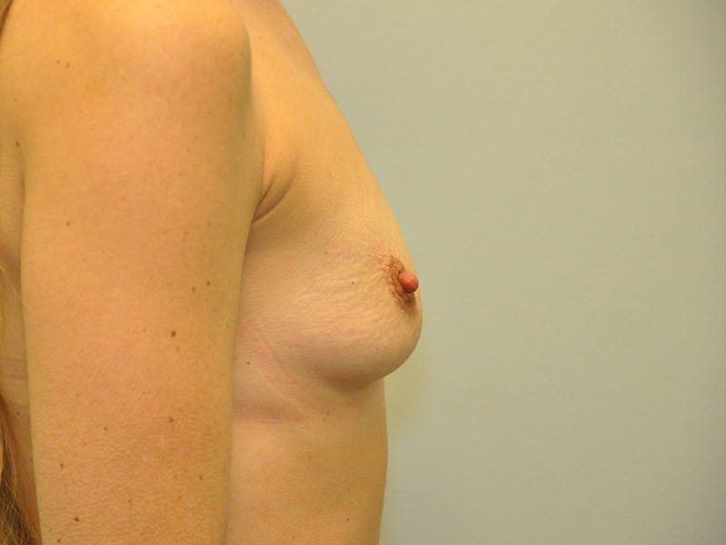 Breast Augmentation Before and After | Steven Ringler MD - Center for Aesthetics And Plastic Surgery