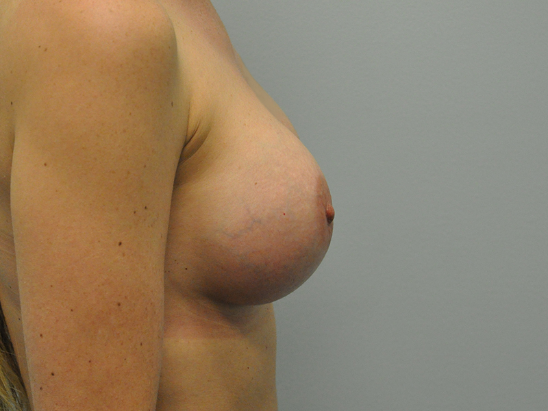 Breast Augmentation Before and After | Steven Ringler MD - Center for Aesthetics And Plastic Surgery